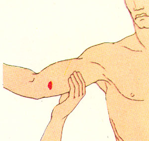 Остановка кровотечения из плечевой артерии